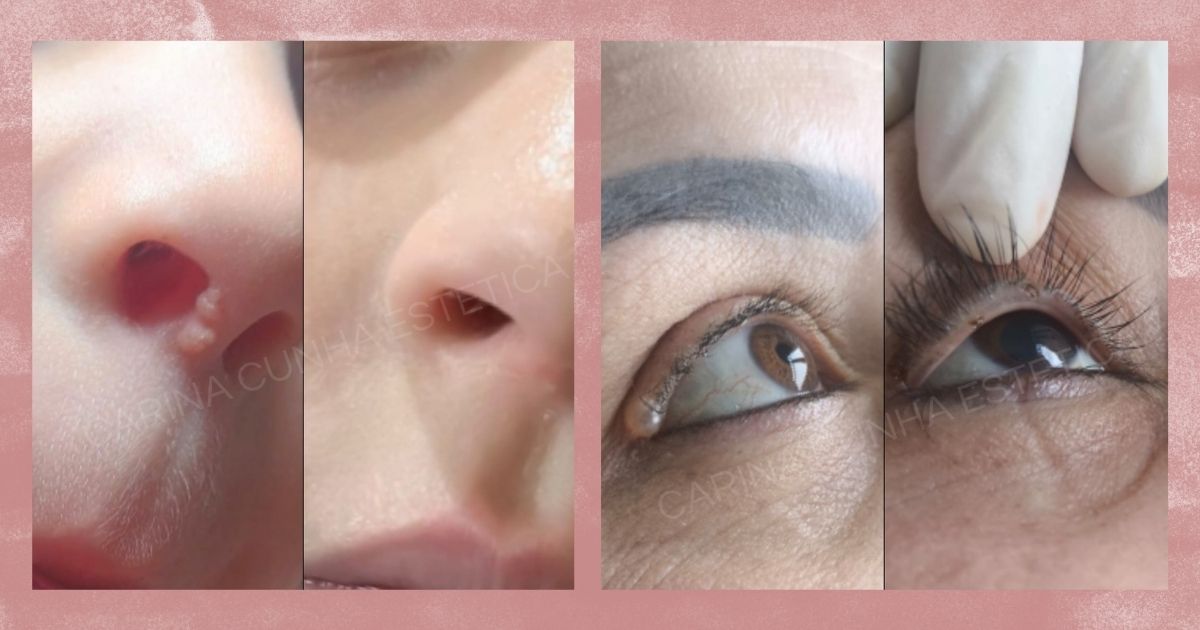 Antes e Depois de Remoção de Acrocórdons